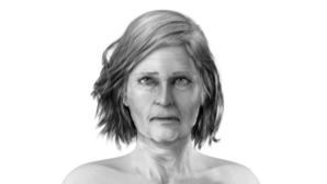 65+-art-filler-anti-aging-fillmed