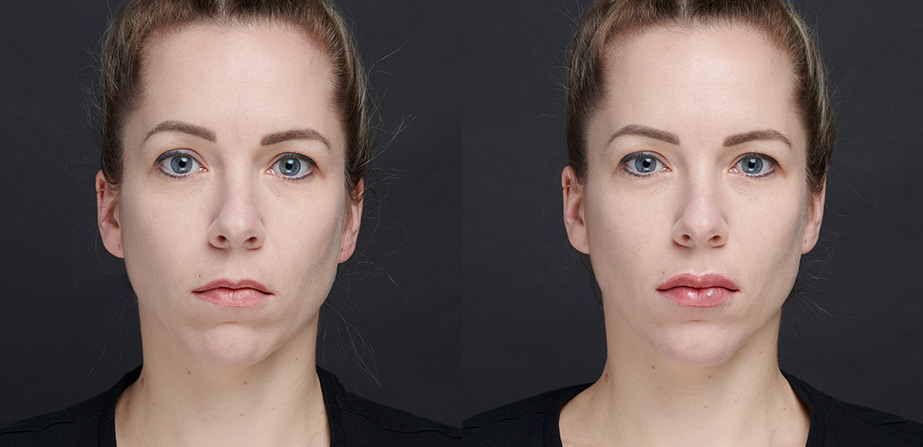 Before After Art Filler Lips Injection