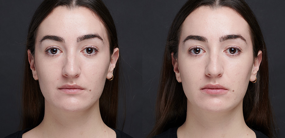 Before After Art Filler Lips Injection