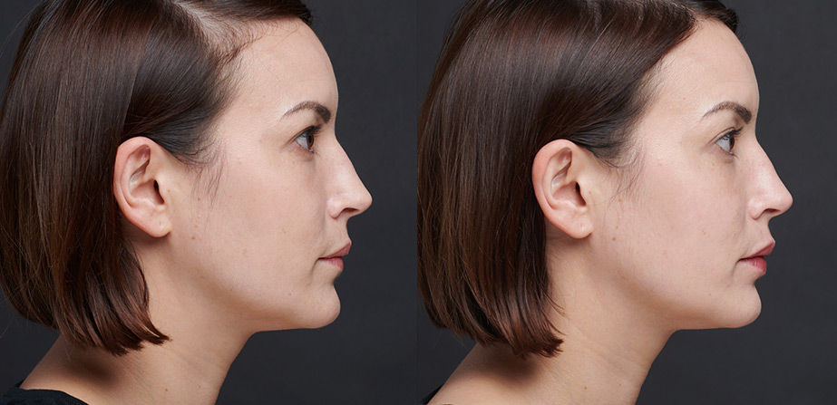 Before After Dermal Filling Injection