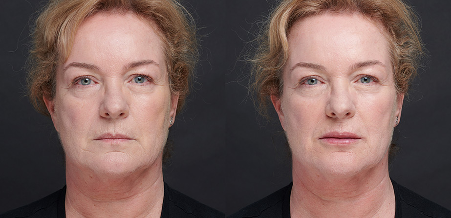 Before After Soft Lips Injection