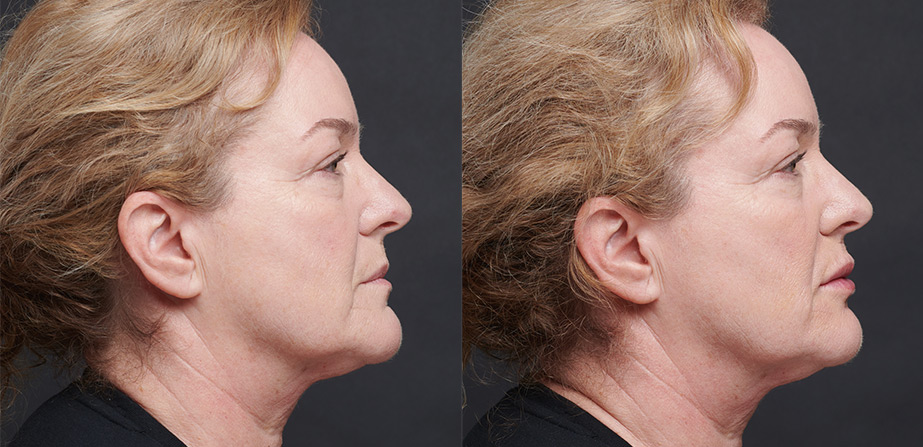 Before After Lip Volume Injection